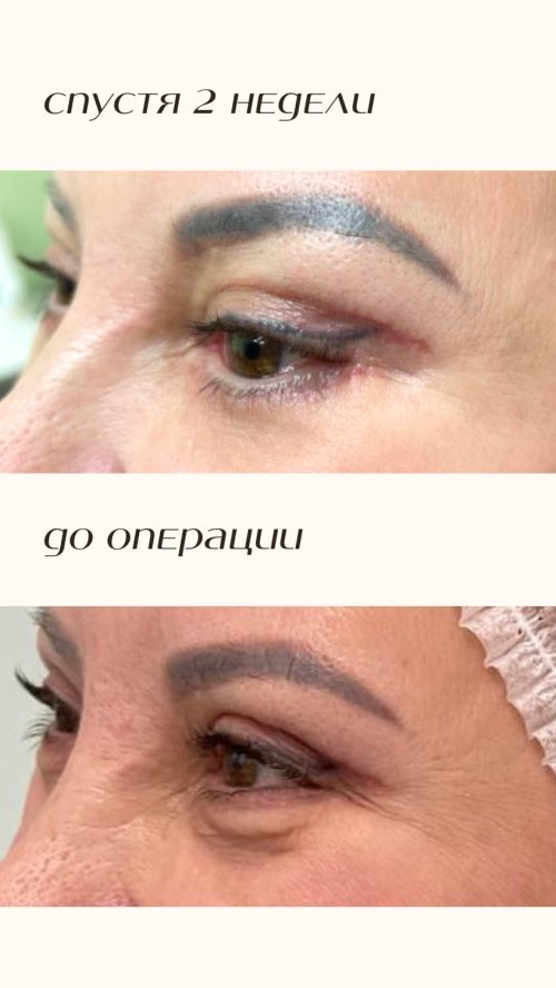 Пластика лица