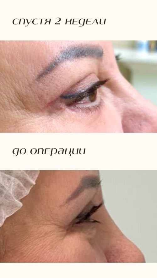 Пластика лица