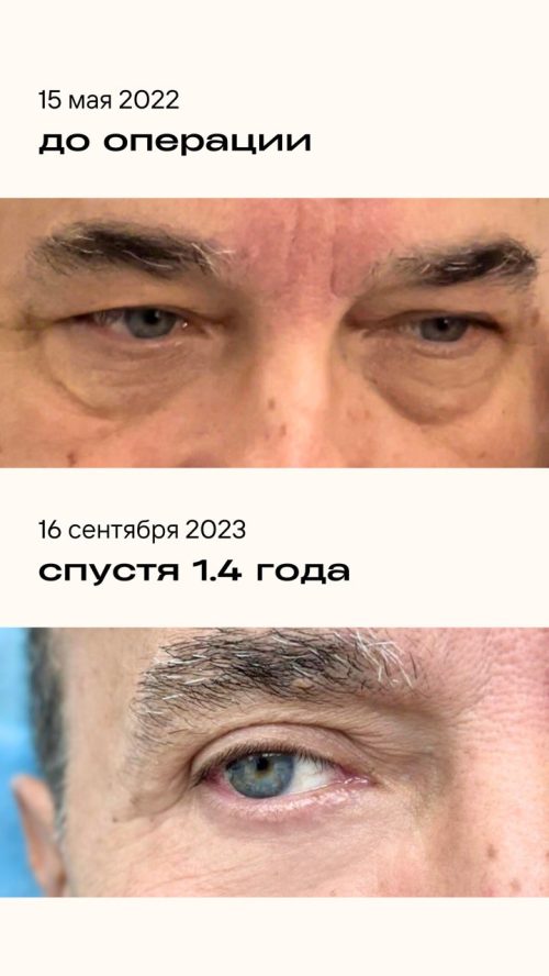 Мужская блефаропластика