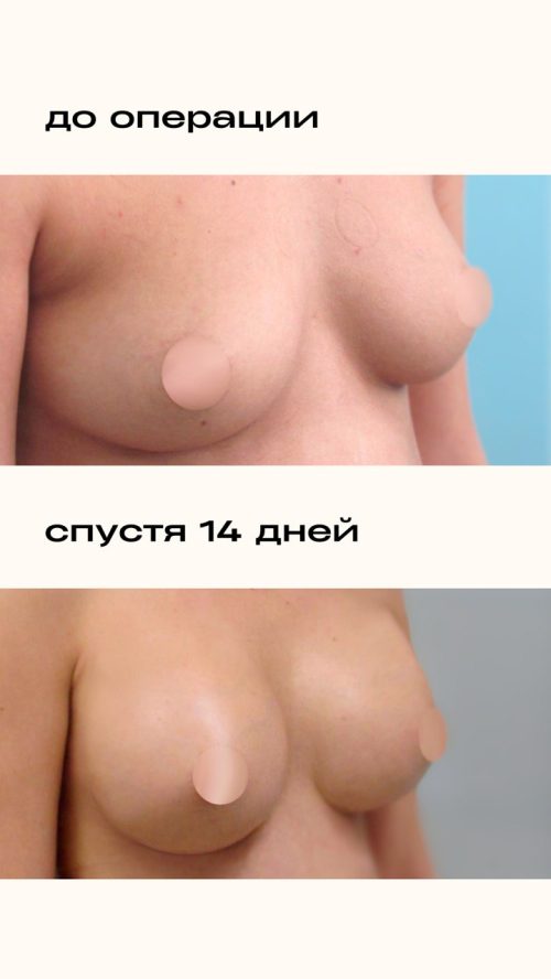 Увеличение груди