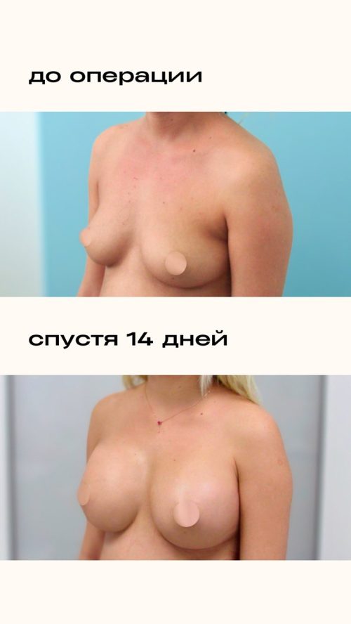 Увеличение груди