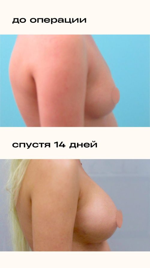 Увеличение груди