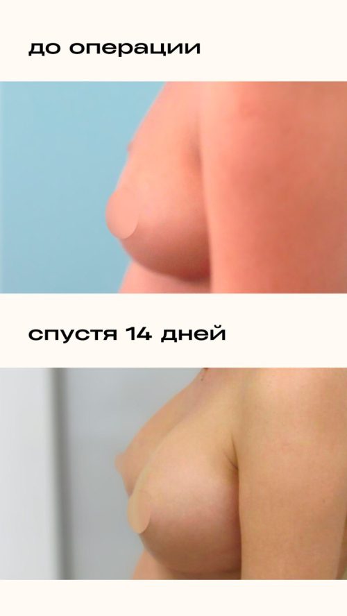 Увеличение груди