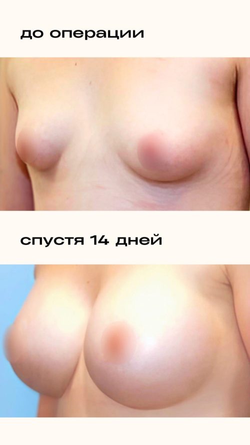 Увеличение груди